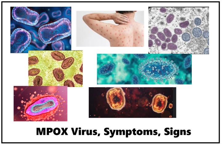 MPOX Virus, Signs, Symptoms, Treatment